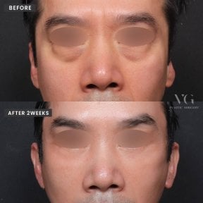 Before and after blepharoplasty results at VG Plastic Surgery, eyelid correction in 2 weeks