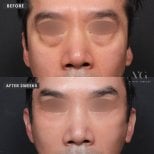 Before and after blepharoplasty results at VG Plastic Surgery, eyelid correction in 2 weeks