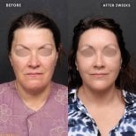 Before and after mini facelift results at VG Plastic Surgery, visible facial rejuvenation