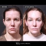 Результаты мини-подтяжки лица до и после в VG Plastic Surgery, видимое омоложение