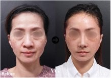 Результаты мини-подтяжки лица до и после в VG Plastic Surgery – омоложение лица