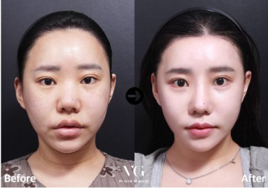 Before and after mini facelift results at VG Plastic Surgery, visible facial rejuvenation effect