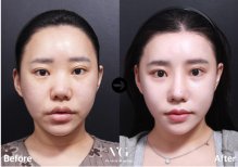 Before and after mini facelift results at VG Plastic Surgery, visible facial rejuvenation effect