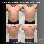 Before and after Vaser abdominal liposuction results at ID Clinic Bangkok, waist and back contour