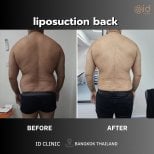 Before and after back liposuction results at ID Clinic Bangkok, visible fat reduction