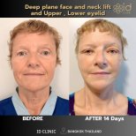 Résultats avant/après lifting visage, cou et paupières à ID Clinic Bangkok