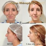Before and after open rhinoplasty results at ID Clinic Bangkok, nose reshaping visible
