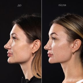 Before and after deep plane facelift results at Vidnova Clinic – visible facial rejuvenation
