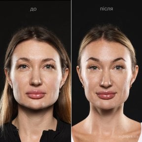 Before and after deep plane facelift results at Vidnova Clinic – facial rejuvenation outcome