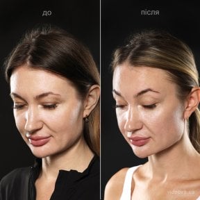 Before and after deep plane facelift results at Vidnova Clinic – visible facial rejuvenation