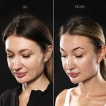 Before and after deep plane facelift results at Vidnova Clinic – visible facial rejuvenation
