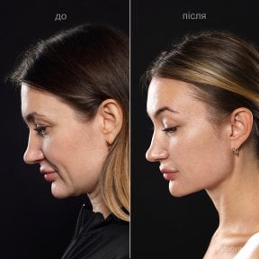 Before and after deep plane facelift result at Vidnova Clinic – visible facial rejuvenation