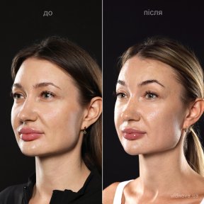 Deep plane facelift before and after results at Vidnova Clinic – visible facial rejuvenation