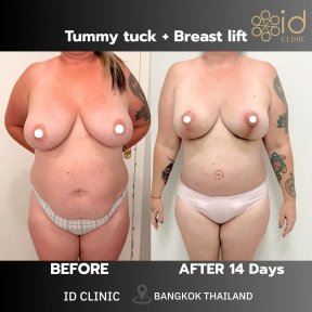before-after photo tightening-of-facial-skin-facelift