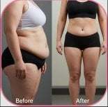 Before and after gastric sleeve surgery results at NOVİN ARİANA SAĞLIK VE TURİZM LİMİTED ŞİRKETİ