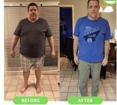 Before and after gastric sleeve surgery results at NOVİN ARİANA SAĞLIK VE TURİZM LİMİTED ŞİRKETİ