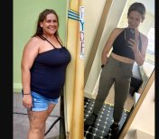 Before and after gastric sleeve surgery at NOVİN ARİANA SAĞLIK – significant weight loss result