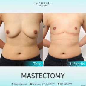 before-after photo gynecomastia-surgery
