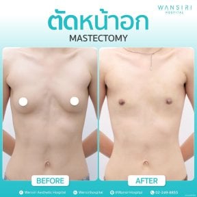 before-after photo gynecomastia-surgery