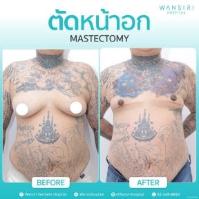 before-after photo gynecomastia-surgery