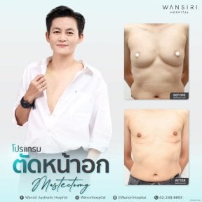 before-after photo gynecomastia-surgery