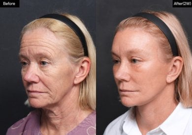 نتائج شد الوجه قبل وبعد في VG Plastic Surgery، تجديد وشد واضح للوجه