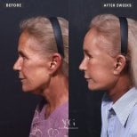 نتائج شد الوجه قبل وبعد في VG Plastic Surgery – تجديد واضح للوجه بعد أسبوعين