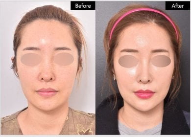 قبل وبعد إزالة دهون الخدود في VG Plastic Surgery، نتيجة وجنتين أنحف واضحة