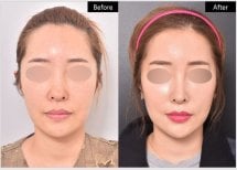 قبل وبعد إزالة دهون الخدود في VG Plastic Surgery، نتيجة وجنتين أنحف واضحة