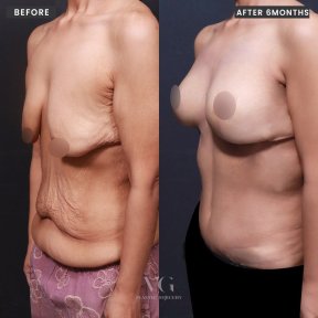 Avant et après liposuccion et remodelage corporel chez VG Plastic Surgery, résultat à 6 mois