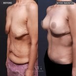 Avant et après liposuccion et remodelage corporel chez VG Plastic Surgery, résultat à 6 mois