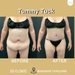 Before and after tummy tuck results at ID Clinic Bangkok, visible abdominal contour improvement