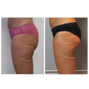 before-after photo 360-liposuction