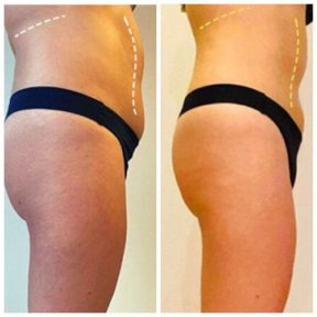 before-after photo 360-liposuction