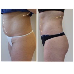 before-after photo 360-liposuction