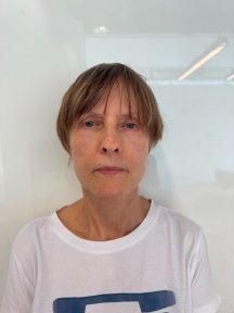 before-after photo blepharoplasty-eyelid