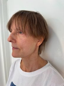 before-after photo blepharoplasty-eyelid