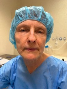 before-after photo blepharoplasty-eyelid
