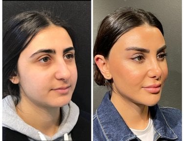 before-after photo rhinoplasty-nose-job