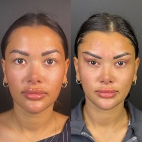 before-after photo rhinoplasty-nose-job