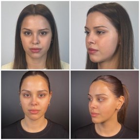 before-after photo rhinoplasty-nose-job