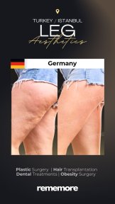 before-after photo thigh-lift