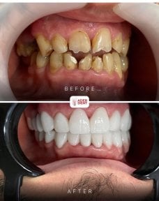 before-after photo smile-makeover