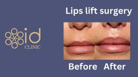 Результаты до и после липлифтинга в ID Clinic Bangkok, видимое улучшение губ