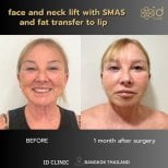 Before and after facelift with SMAS and fat transfer to lips at ID Clinic Bangkok results