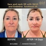 Before and after facelift and neck lift results at ID Clinic Bangkok, visible rejuvenation after 14 days