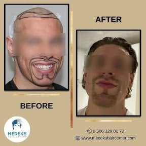 Résultats avant et après greffe de barbe et cheveux au Medeks Hair Center, aspect naturel