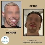 Résultats avant et après greffe de barbe et cheveux au Medeks Hair Center, aspect naturel