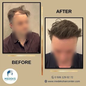 Résultat greffe de cheveux FUE avant/après au Medeks Hair Center, ligne capillaire restaurée