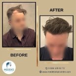 Résultat greffe de cheveux FUE avant/après au Medeks Hair Center, ligne capillaire restaurée